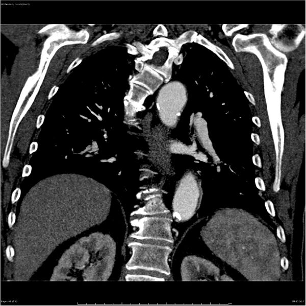 File:Aortic dissection - Stanford type A (Radiopaedia 26183-26315 A 48).jpg