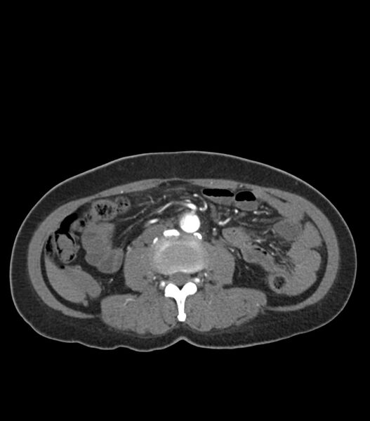 File:Aortic dissection with renal ischemia (Radiopaedia 76573-88338 A 80).jpg