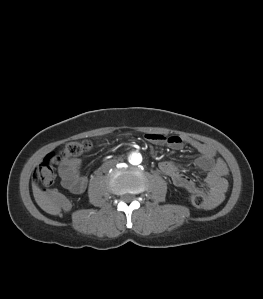Aortic dissection with renal ischemia (Radiopaedia 76573-88338 A 80).jpg