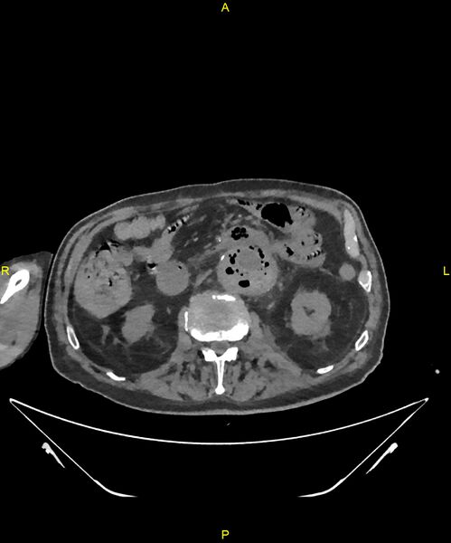 File:Aortoenteric fistula (Radiopaedia 84308-99603 Axial non-contrast 152).jpg