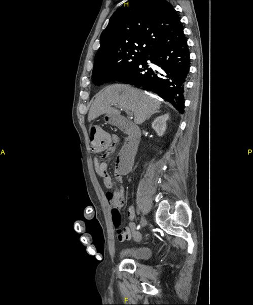 File:Aortoenteric fistula (Radiopaedia 84308-99603 C 128).jpg