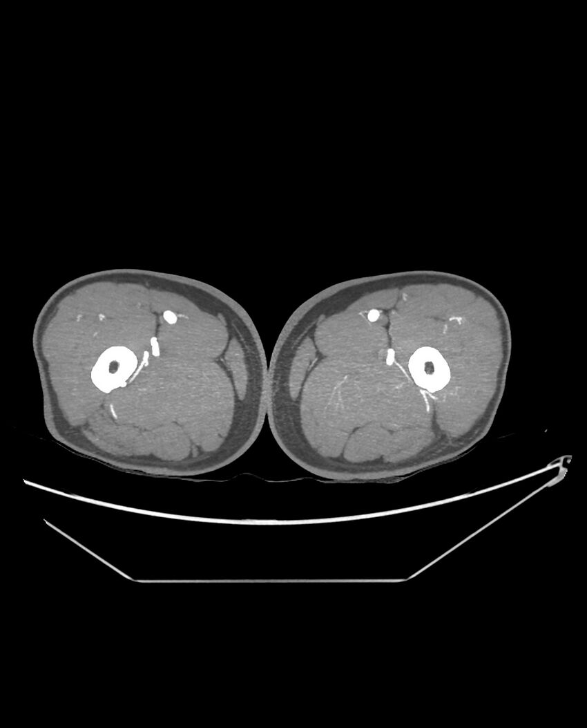 Aplastic posterior tibial arteries (Radiopaedia 84021-99249 A 125).jpg