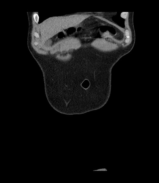 File:Appendiceal mucocele (Radiopaedia 86110-102060 Coronal non-contrast 4).jpg