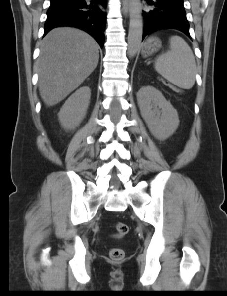 File:Appendicitis and giant appendicolith (Radiopaedia 80251-93588 Coronal non-contrast 34).jpg