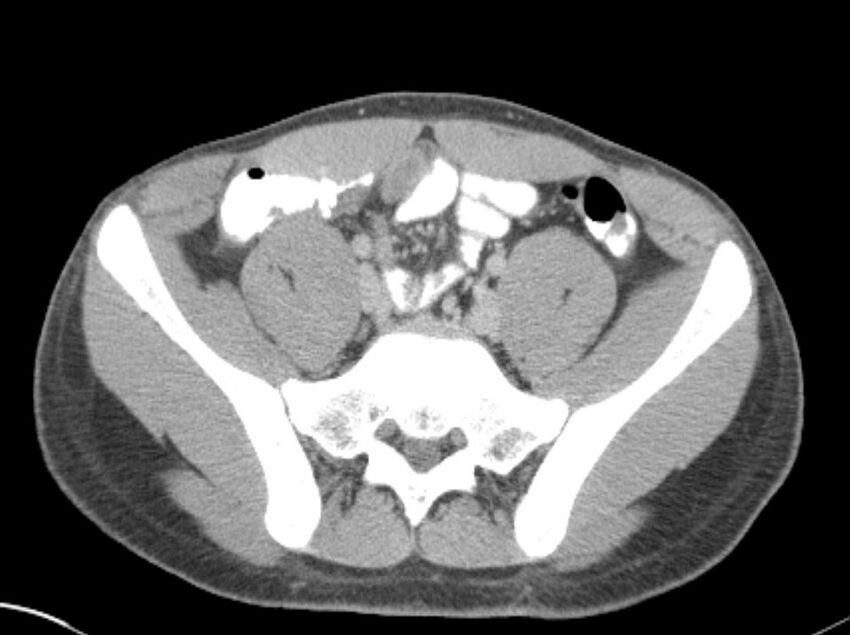 Appendicitis and incidental foregut duplication cyst (Radiopaedia 52962-58916 A 67).jpg