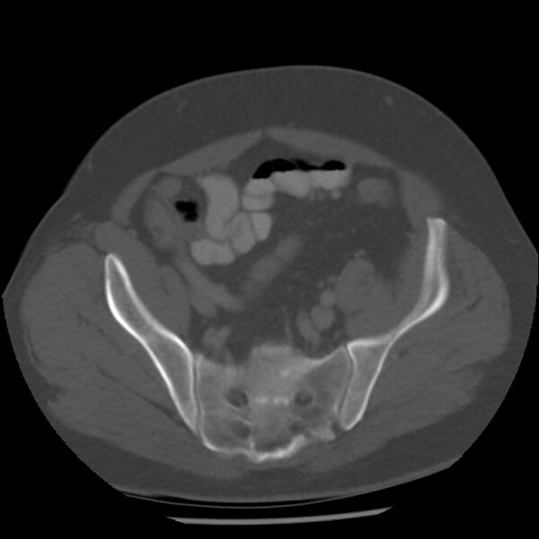File:Appendicitis with perforation (Radiopaedia 35790-37342 Axial bone window 42).jpg