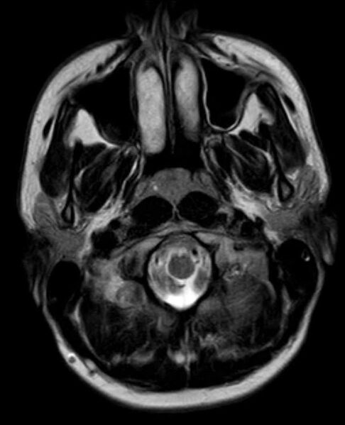 File:Arachnoid cyst- extremely large (Radiopaedia 68741-78451 Axial T2 3).jpg
