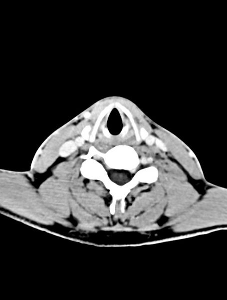 File:Arrow injury to the face (Radiopaedia 73267-84011 Axial C+ delayed 3).jpg