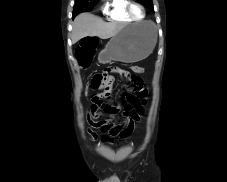 File:Arterial occlusive mesenteric ischemia (Radiopaedia 84641-100060 B 12).jpg