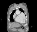 Ascending aortic aneurysm (Radiopaedia 86279-102297 B 5).jpg