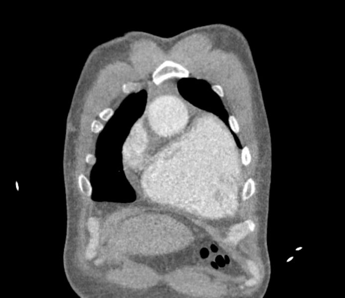 File:Ascending aortic aneurysm (Radiopaedia 86279-102297 B 5).jpg