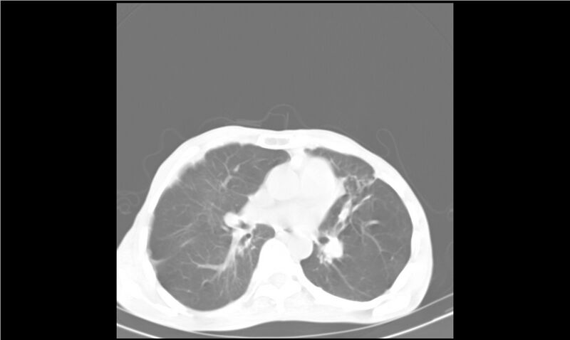 File:Aspergilloma (Radiopaedia 20788-20701 Axial lung window 18).jpg