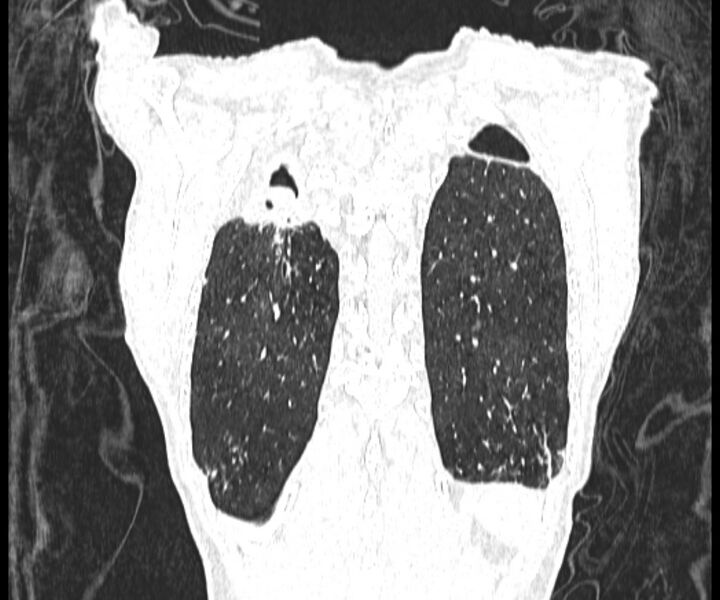 File:Aspergillomas (Radiopaedia 66779-76110 Coronal lung window 19).jpg