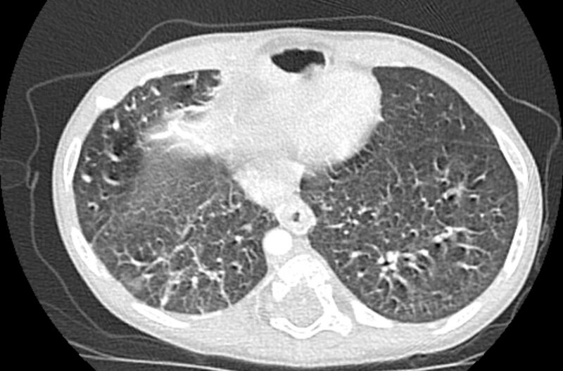 File:Asplenia syndrome (Radiopaedia 73083-83792 Axial lung window 58).jpg