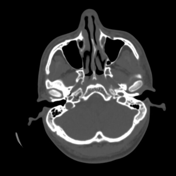 File:Asymptomatic occipital spur (Radiopaedia 87753-104201 Axial bone window 24).jpg