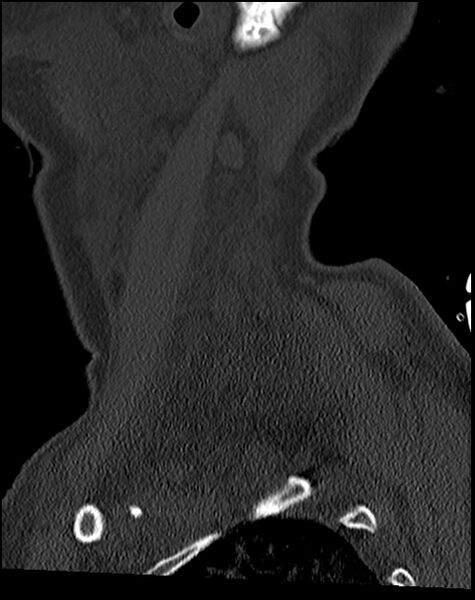 File:Atlanto-occipital dissociation - Traynelis type 1 (Radiopaedia 87570-103948 Sagittal bone window 73).jpg