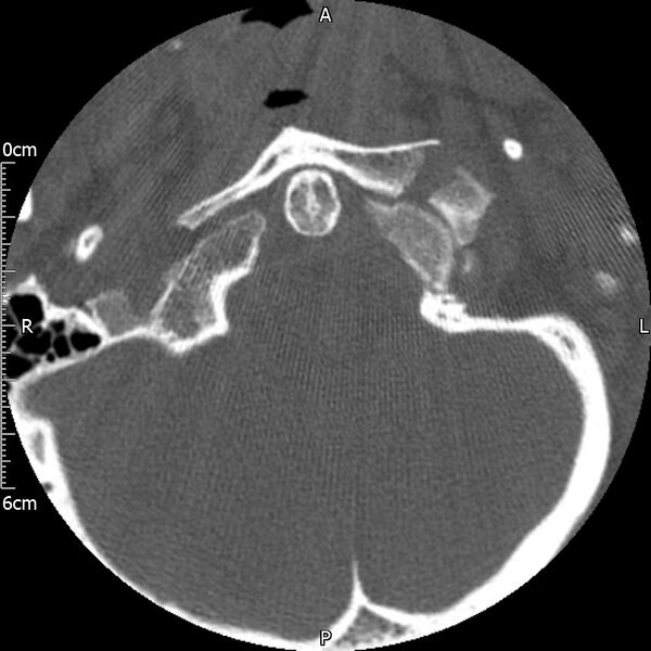 File:Atlas fracture with Currarino type A congenital defect (Radiopaedia 71747-82144 Axial bone window 21).jpg