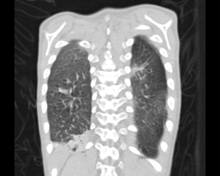File:Atrial septal defect complicated by Eisenmenger syndrome (Radiopaedia 53707-59768 Sagittal lung window 20).jpg
