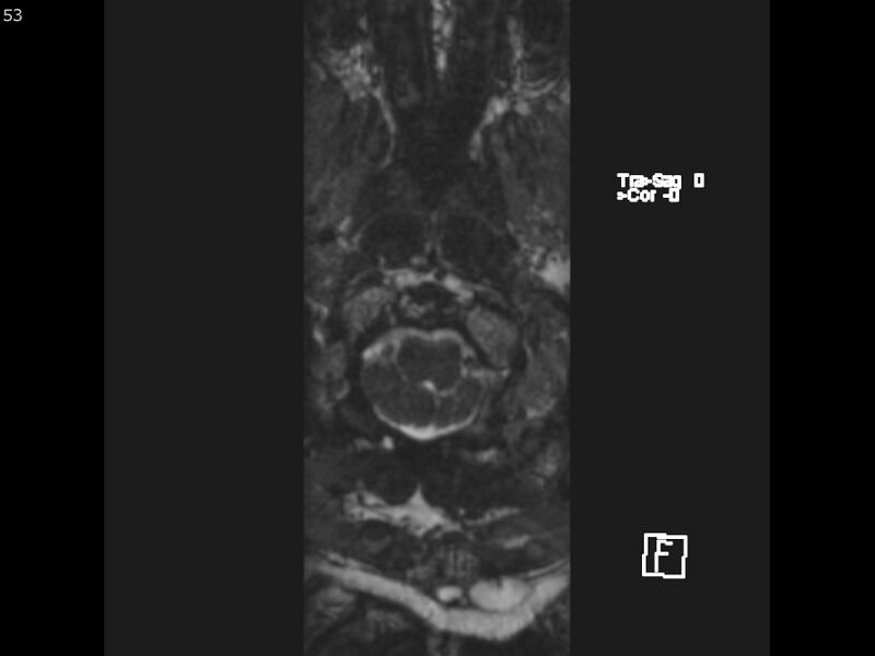 File:Atypical meningioma - intraosseous (Radiopaedia 64915-74572 Axial CISS 53).jpg