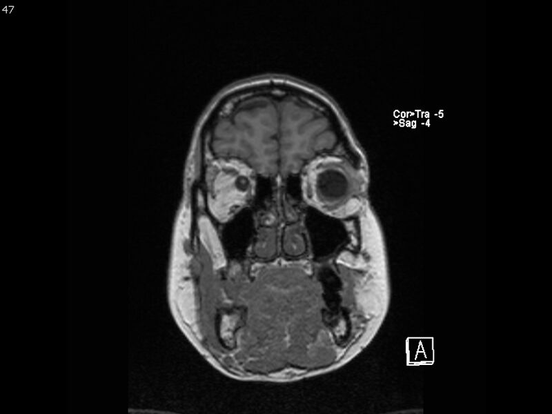 File:Atypical meningioma - intraosseous (Radiopaedia 64915-74572 Coronal T1 47).jpg
