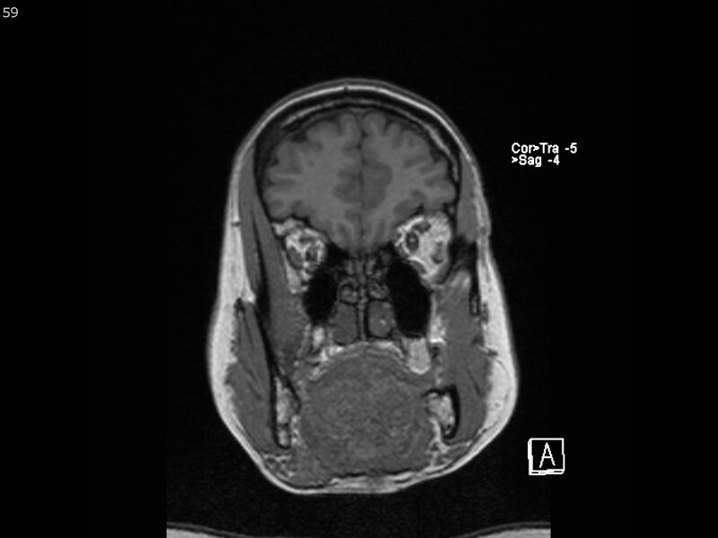 File:Atypical meningioma - intraosseous (Radiopaedia 64915-74572 Coronal T1 59).jpg