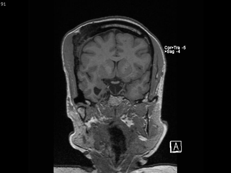 File:Atypical meningioma - intraosseous (Radiopaedia 64915-74572 Coronal T1 91).jpg