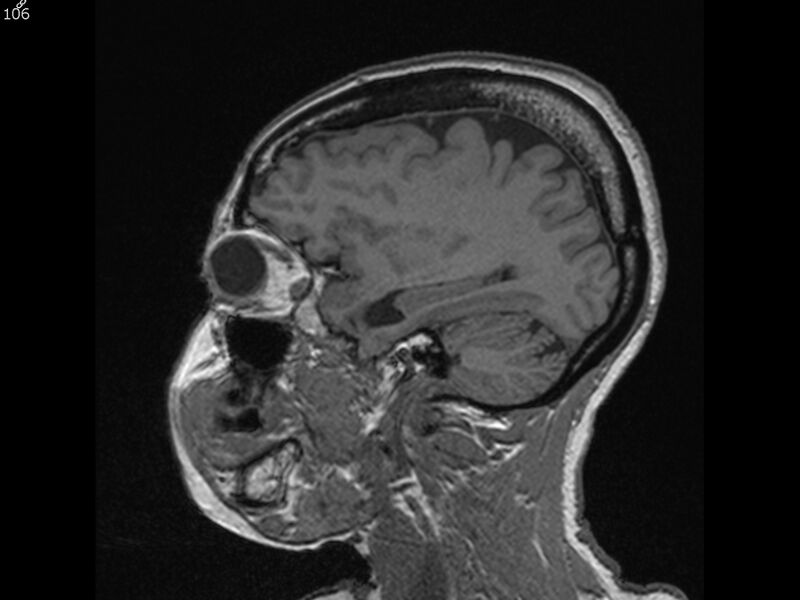 File:Atypical meningioma - intraosseous (Radiopaedia 64915-74572 Sagittal T1 106).jpg