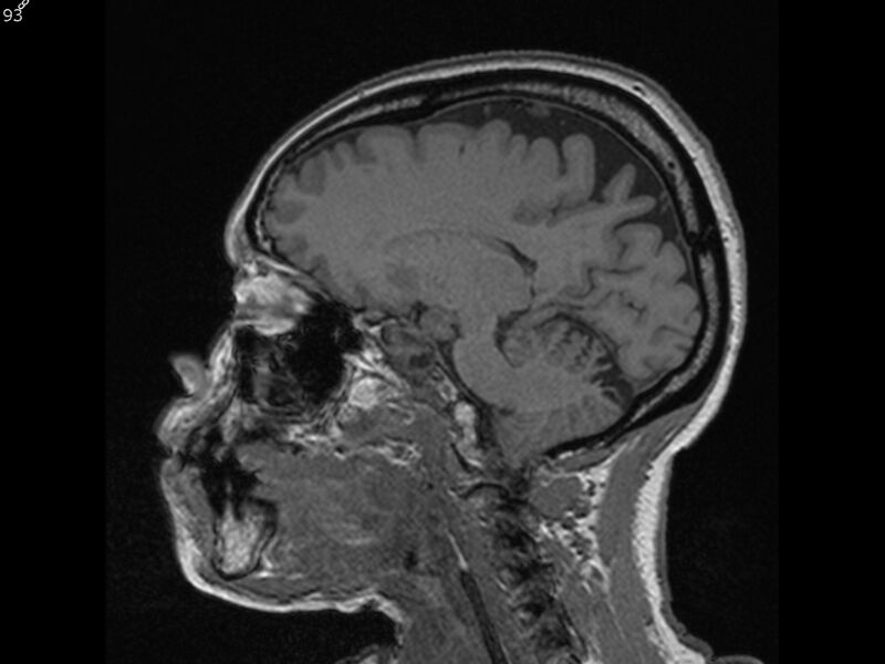 File:Atypical meningioma - intraosseous (Radiopaedia 64915-74572 Sagittal T1 93).jpg