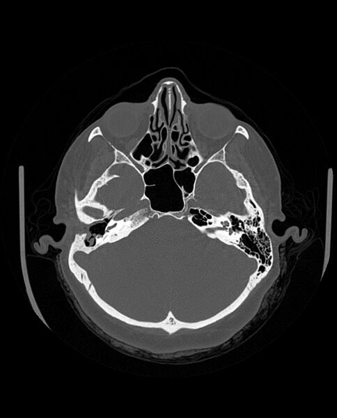 File:Automastoidectomy with labyrinthine fistula (Radiopaedia 84143-99411 Axial non-contrast 86).jpg