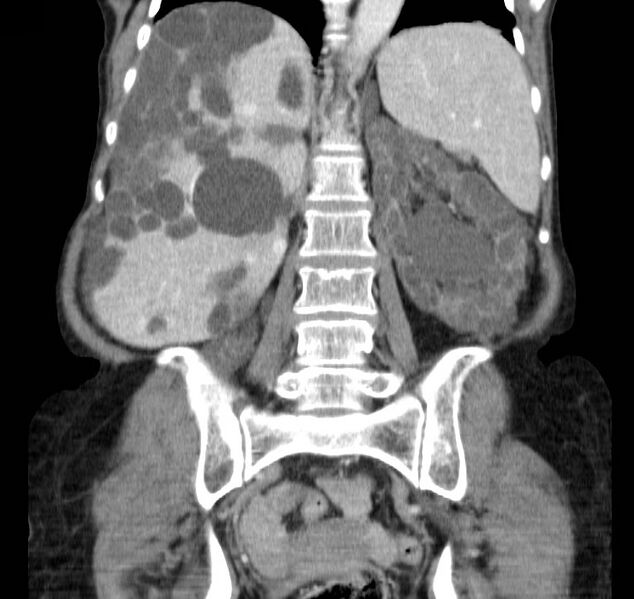 File:Autosomal dominant polycystic kidney disease (Radiopaedia 16777-16490 B 32).jpg