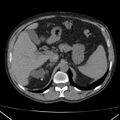Autosomal dominant polycystic kidney disease (Radiopaedia 36539-38101 Axial non-contrast 22).jpg