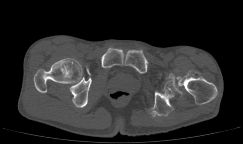 File:Avascular necrosis of the left hip (Radiopaedia 75068-86125 Axial bone window 75).jpg