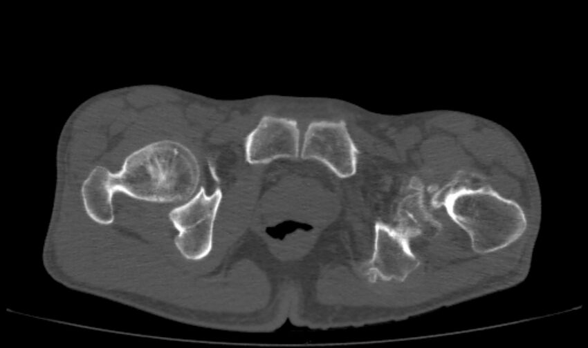 Avascular necrosis of the left hip (Radiopaedia 75068-86125 Axial bone window 75).jpg