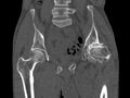 Avascular necrosis of the left hip (Radiopaedia 75068-86125 Coronal bone window 31).jpg