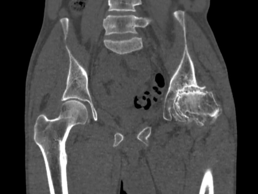Avascular necrosis of the left hip (Radiopaedia 75068-86125 Coronal bone window 31).jpg
