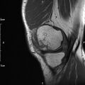 Avulsion fracture of the fibular head (Radiopaedia 74804-85808 D 8).jpg