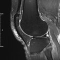 Avulsion fracture of the fibular head (Radiopaedia 74804-85808 Sagittal PD fat sat 24).jpg