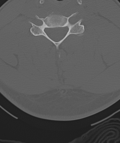 File:Axis peg fracture (type 3) and atlas lateral mass (type 4) fracture (Radiopaedia 37474-39324 Axial bone window 35).png