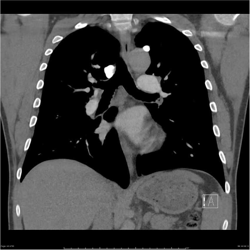 Azygos venous system anatomy (CT pulmonary angiography) (Radiopaedia 25928-26077 Coronal C+ CTPA 43).jpg
