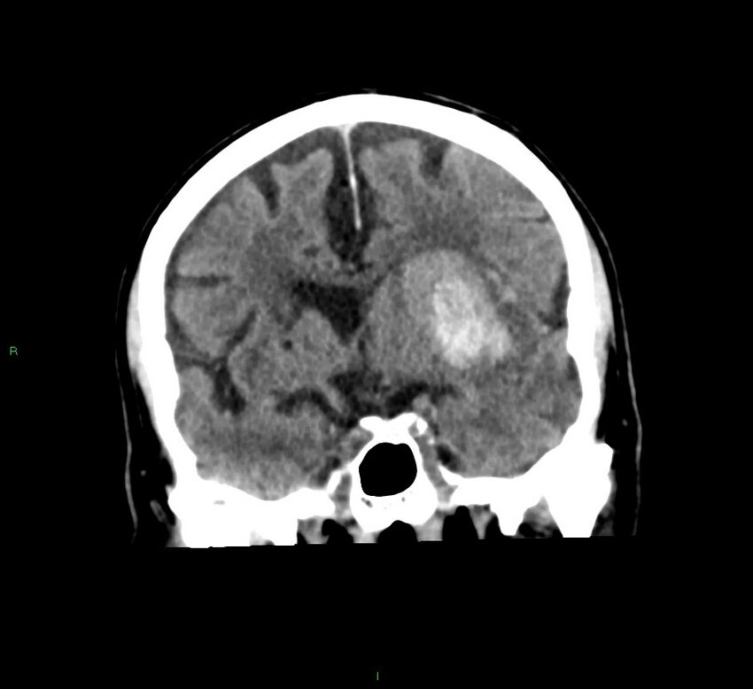 Basal ganglia hemorrhage (Radiopaedia 58791-66025 Coronal non-contrast 38).jpg