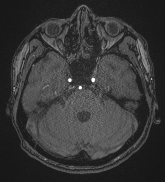 File:Basal ganglia subacute infarct (Radiopaedia 80201-93521 Axial MRA 25).png