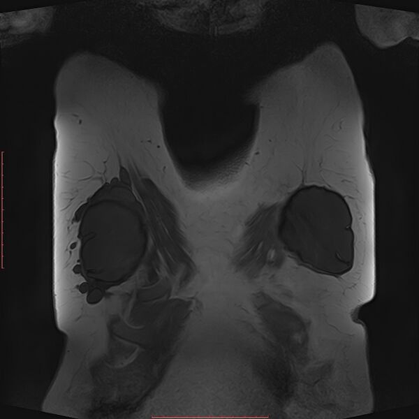 File:Bilateral breast implant rupture (Radiopaedia 24761-25027 G 51).jpg
