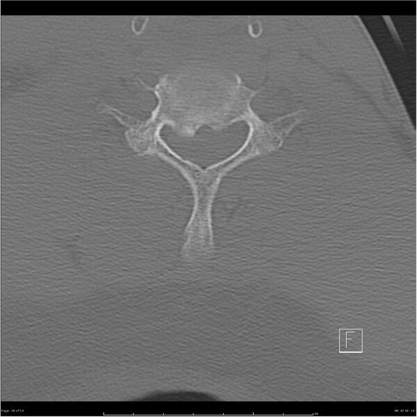 File:Bilateral cervical ribs (Radiopaedia 25868-26017 Axial bone window 36).jpg