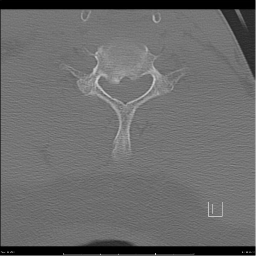 Bilateral cervical ribs (Radiopaedia 25868-26017 Axial bone window 36).jpg