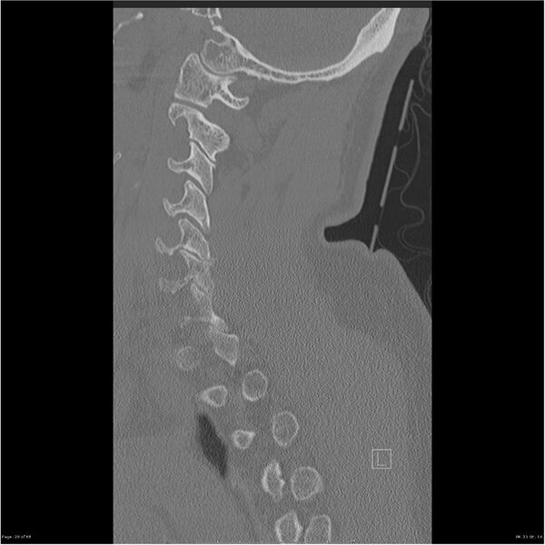 File:Bilateral cervical ribs (Radiopaedia 25868-26017 Sagittal bone window 20).jpg