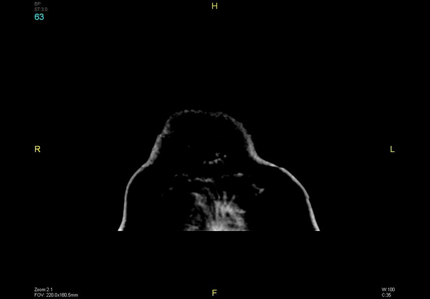 Bilateral medial medullary infarction (Radiopaedia 42220-45295 Coronal non-contrast 63).jpg
