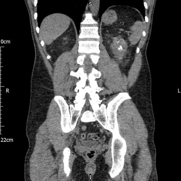 File:Bilateral medullary nephrocalcinosis with ureteric calculi (Radiopaedia 71269-81569 Coronal non-contrast 52).jpg