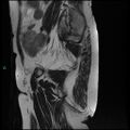 Bilateral ovarian fibroma (Radiopaedia 44568-48293 Sagittal T2 7).jpg
