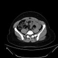 Bilateral ovarian mature cystic teratomas (Radiopaedia 79373-92457 Axial non-contrast 40).jpg