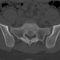 Bilateral pars defect (Radiopaedia 26691-26846 Axial bone window 81).jpg